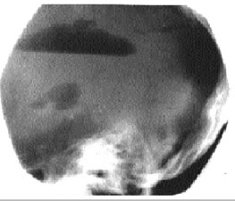 pneumoencephalogram X-ray image of brain