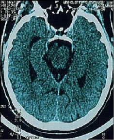 CT image of brain