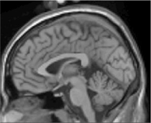 MRI iamge of brain