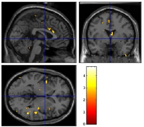 3 MRI images of brain